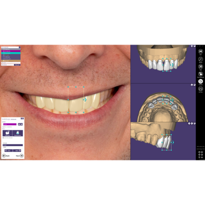 Exocad Smile Creator - модуль для планирования улыбки | Exocad (Германия)