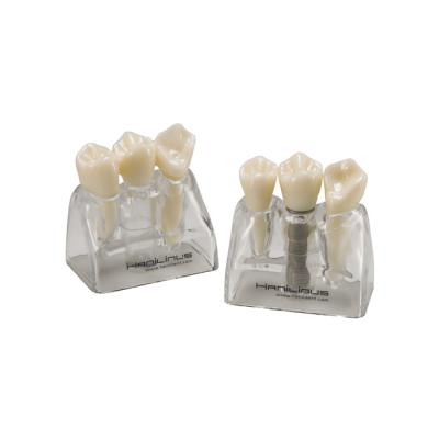 MODEL 3000 - модели, демонстрирующие имплантат и зубной мост | Hanil (Ю. Корея)