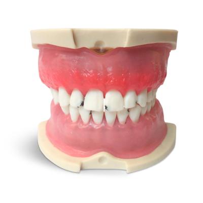 E826  – модель верхней и нижней челюсти с пародонтопатологией для практики | GF Dental (Италия)