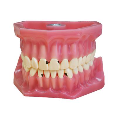 ЧВН-32К - денто-модель верхней и нижней челюстей для практики лечения кариеса | Зарница (Россия)
