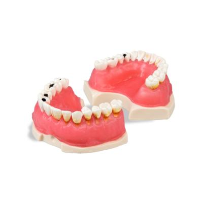 E26  – модель верхней и нижней челюсти с пародонтопатологий для практики | GF Dental (Италия)
