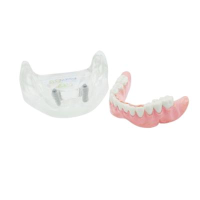 T11 – демонстрационная модель нижней челюсти с имплантами | GF Dental (Италия)