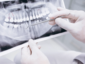 Новое зубное покрытие поможет в борьбе с кариесом и восстановить эмаль Новое зубное покрытие поможет в борьбе с кариесом и восстановить эмаль